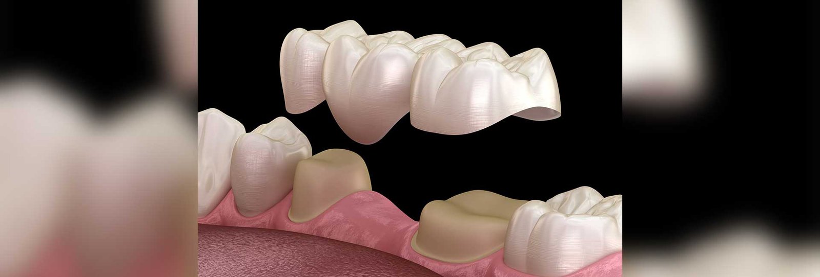 Dental bridges