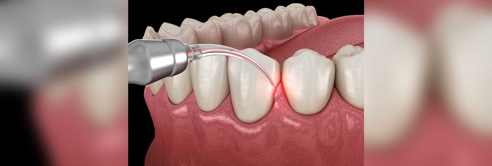 Gum correction surgery with laser. Medically accurate tooth 3D illustration