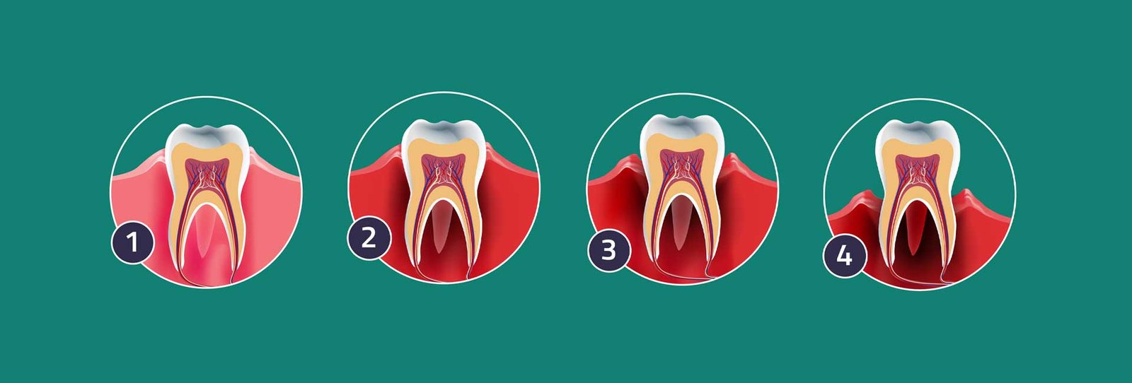 Periodontal Health/ Hygiene