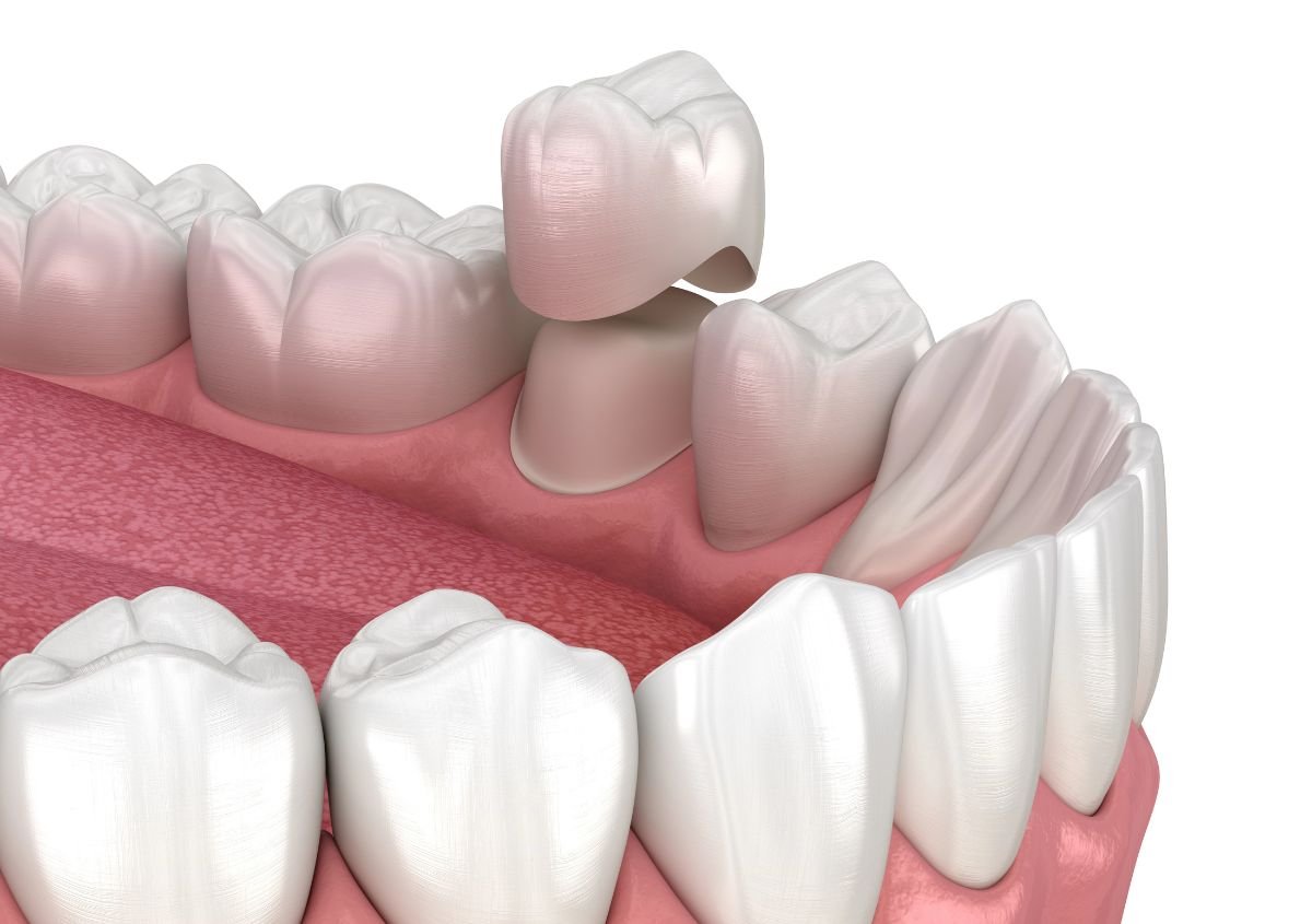 Dental Crowns: How to Identify When Something is Wrong