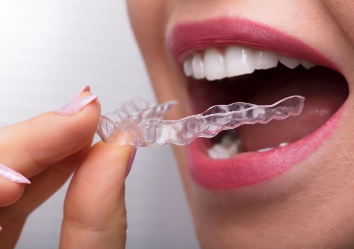 Does Invisalign Affect What I Eat? A Complete Guide from Happy Smiles