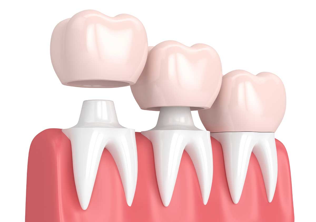 What you need to know about dental crowns